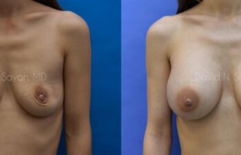 Breast Augmentation Before and After | Sayah Institute