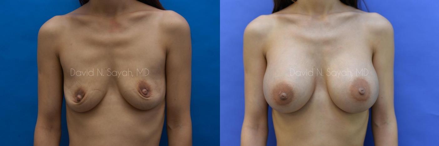 Breast Augmentation Before and After | Sayah Institute