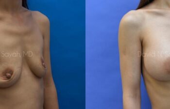 Breast Augmentation Before and After | Sayah Institute