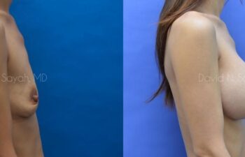 Breast Augmentation Before and After | Sayah Institute