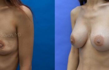 Breast Augmentation Before and After | Sayah Institute