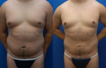 Liposuction Before and After | Sayah Institute