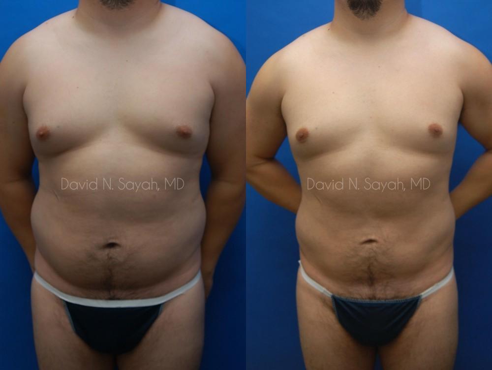 Liposuction Before and After | Sayah Institute