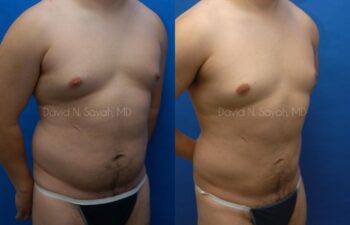 Liposuction Before and After | Sayah Institute