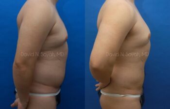 Liposuction Before and After | Sayah Institute