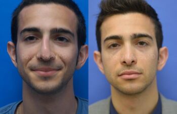 Rhinoplasty Before and After | Sayah Institute
