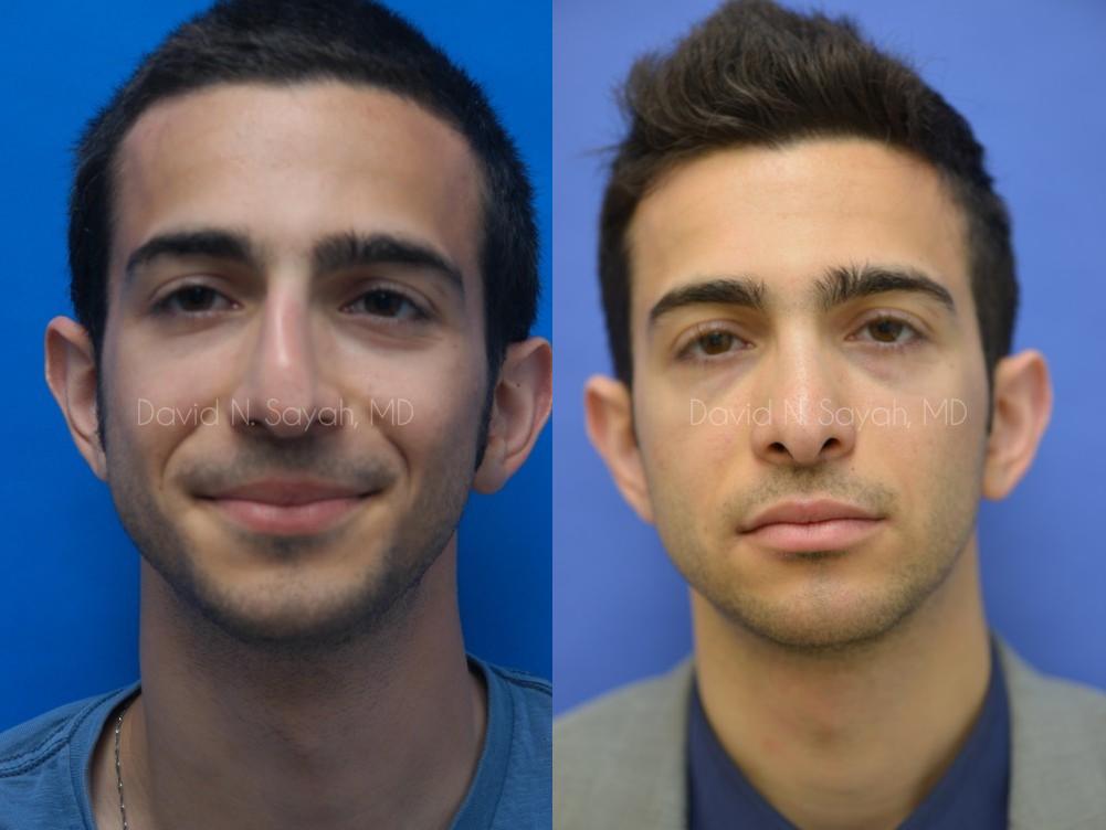 Rhinoplasty Before and After | Sayah Institute