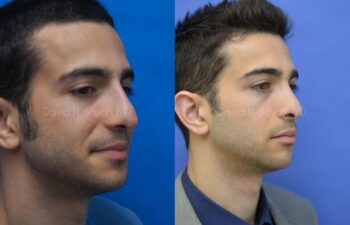 Rhinoplasty Before and After | Sayah Institute