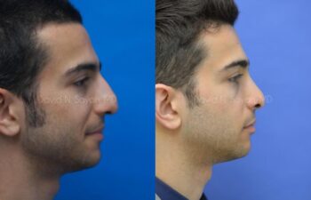 Rhinoplasty Before and After | Sayah Institute