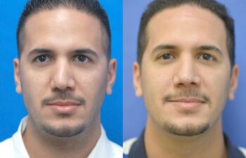 Rhinoplasty Before and After | Sayah Institute