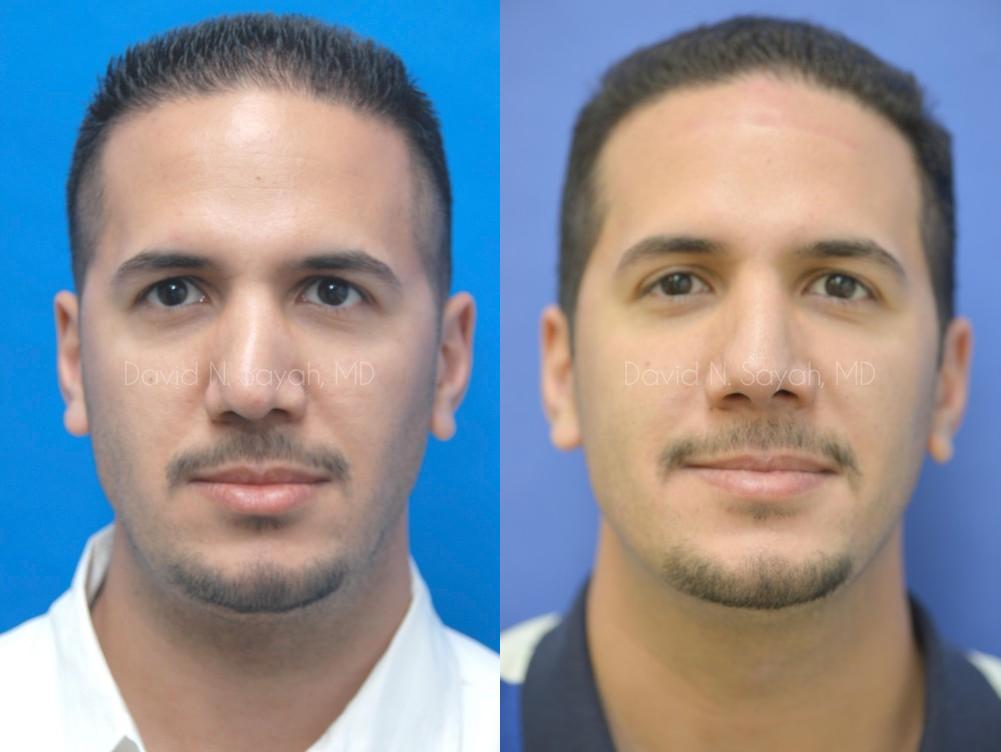 Rhinoplasty Before and After | Sayah Institute