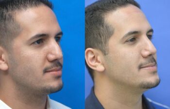 Rhinoplasty Before and After | Sayah Institute