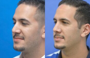 Rhinoplasty Before and After | Sayah Institute