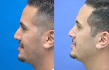 Rhinoplasty Before and After | Sayah Institute