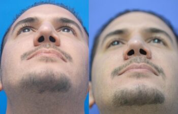 Rhinoplasty Before and After | Sayah Institute