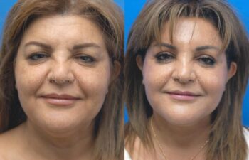Brow Lift Before and After | Sayah Institute