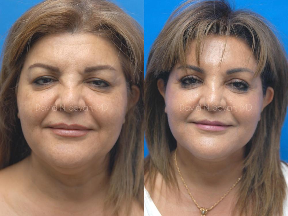 Brow Lift Before and After | Sayah Institute