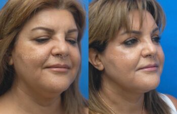 Brow Lift Before and After | Sayah Institute