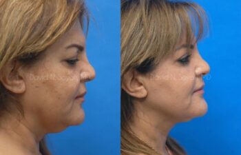 Brow Lift Before and After | Sayah Institute