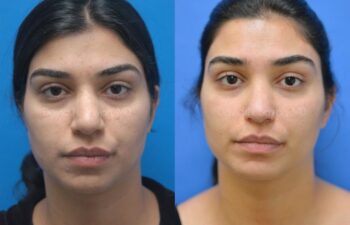 Rhinoplasty Before and After | Sayah Institute