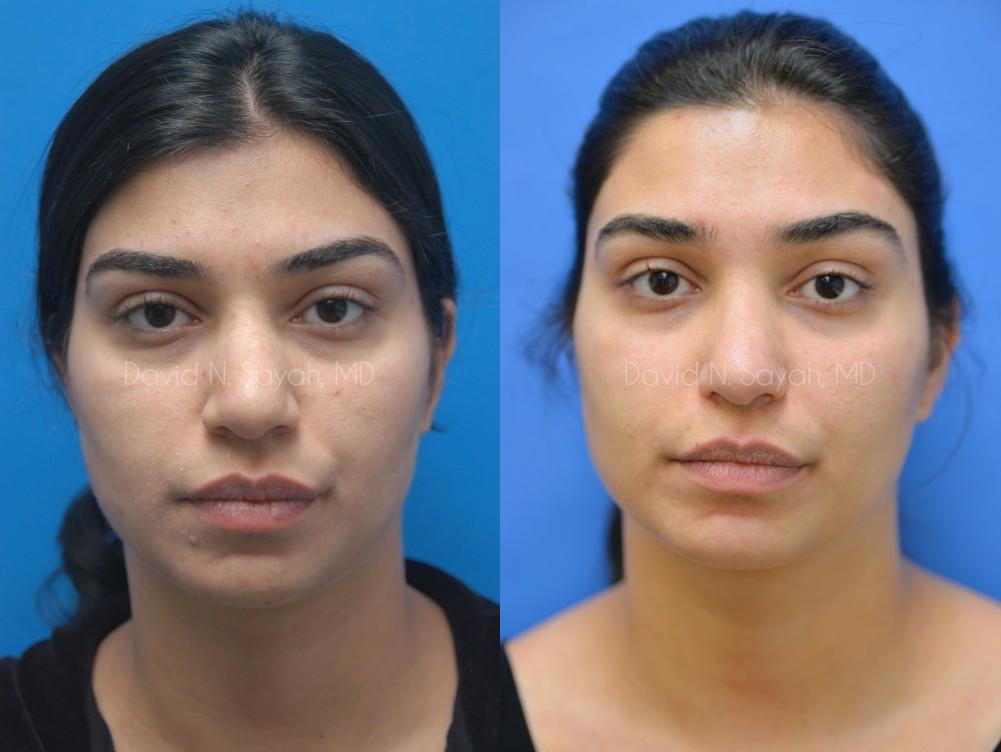Rhinoplasty Before and After | Sayah Institute