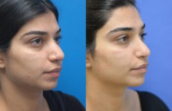 Rhinoplasty Before and After | Sayah Institute