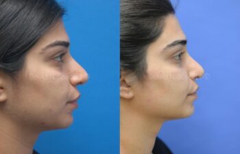 Rhinoplasty Before and After | Sayah Institute
