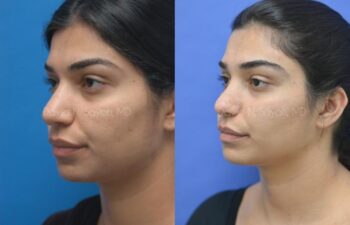 Rhinoplasty Before and After | Sayah Institute