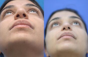 Rhinoplasty Before and After | Sayah Institute