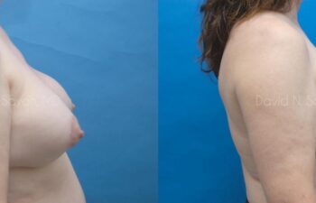 Breast Implant Exchange Before and After | Sayah Institute