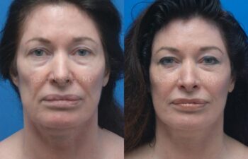 Facelift Before and After | Sayah Institute
