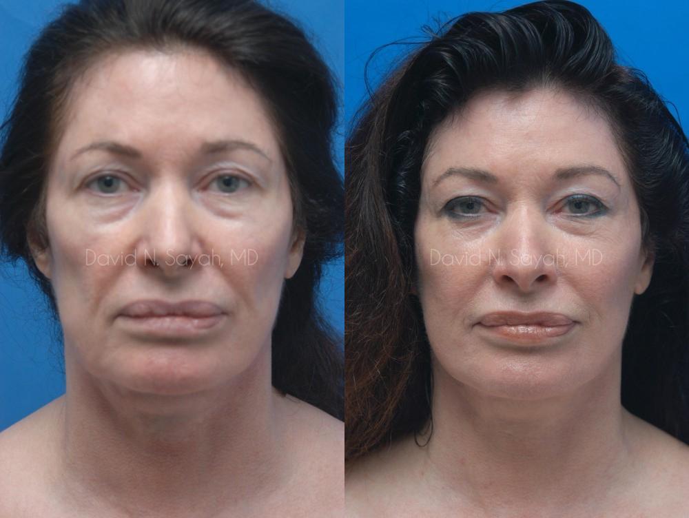 Facelift Before and After | Sayah Institute