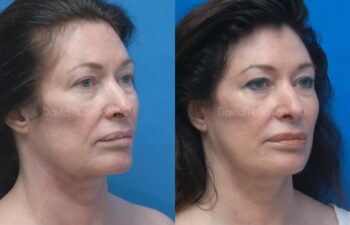 Facelift Before and After | Sayah Institute