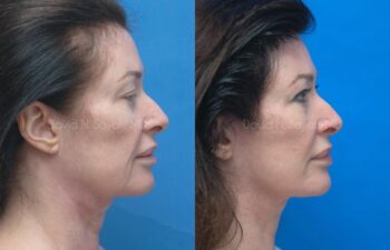 Facelift Before and After | Sayah Institute