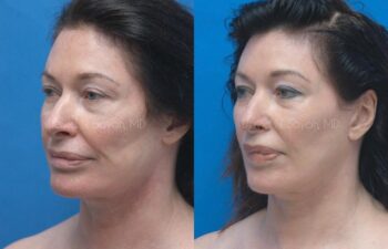 Facelift Before and After | Sayah Institute