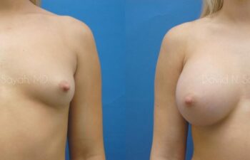 Breast Augmentation Before and After | Sayah Institute