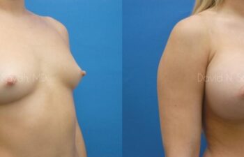 Breast Augmentation Before and After | Sayah Institute