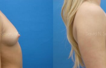 Breast Augmentation Before and After | Sayah Institute