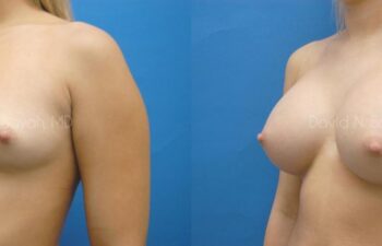 Breast Augmentation Before and After | Sayah Institute