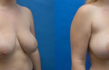 Breast Reduction Before and After | Sayah Institute