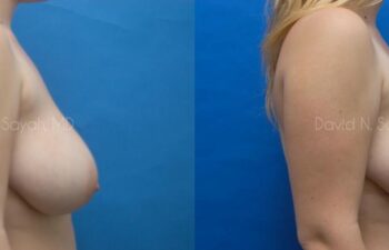 Breast Reduction Before and After | Sayah Institute