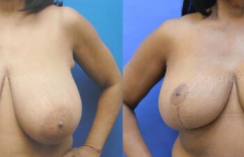 Breast Reduction Before and After | Sayah Institute