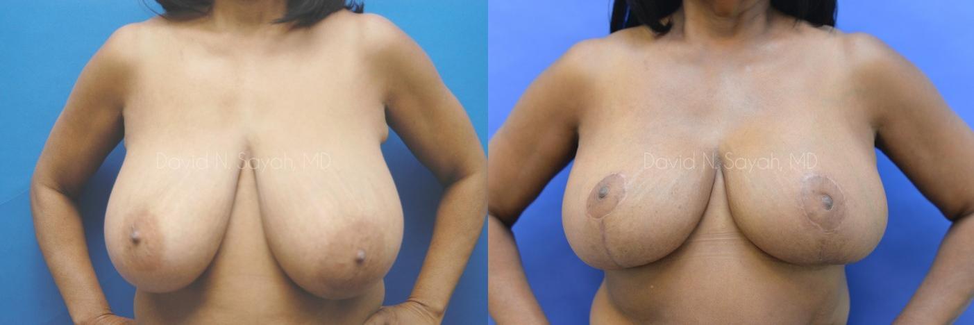 Breast Reduction Before and After | Sayah Institute
