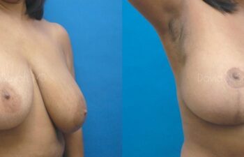 Breast Reduction Before and After | Sayah Institute