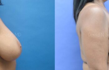 Breast Reduction Before and After | Sayah Institute