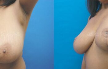 Breast Reduction Before and After | Sayah Institute