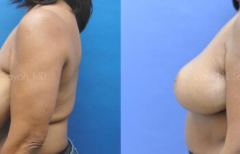 Breast Reduction Before and After | Sayah Institute