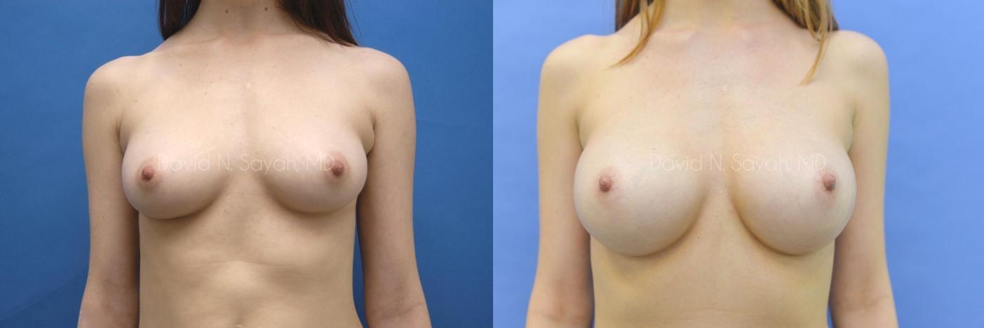 Breast Augmentation Before and After | Sayah Institute