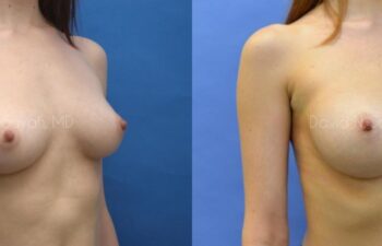 Breast Augmentation Before and After | Sayah Institute