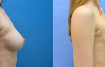 Breast Augmentation Before and After | Sayah Institute